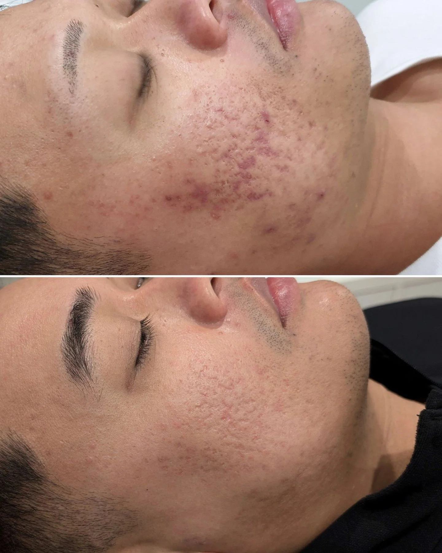 ✨ Glowing skin doesn't happen overnight, but trust us, it&rsquo;s worth the journey! 💪💖

Ever feel like your skin is staging a little rebellion when you switch up your skincare? 😩 Don&rsquo;t worry&mdash;this is totally normal! Sometimes, your ski