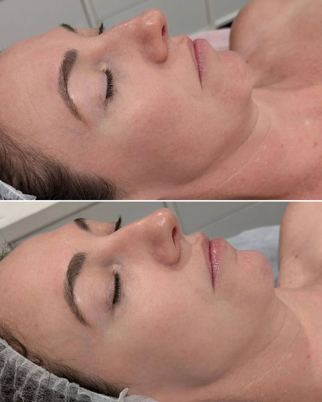 This is what healthy, cared for skin looks like.

Let us help guide you to achieving skin that functions as it should and naturally glows 💫

#skinclinic #professionalskintreatment #canningvaleskinclinic #healthyskingoals #plumpskin #skinwellness #ha