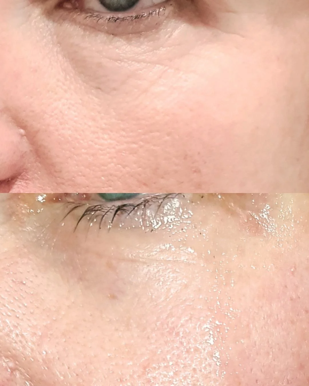 ✨ ONE TREATMENT ✨

Plasma Fibroblast can remove wrinkles and loose skin as it has a tightening effect on skin that has lost its firmness, with results that last as long as they would with a surgical procedure &ndash; for a fraction of the cost! Becau