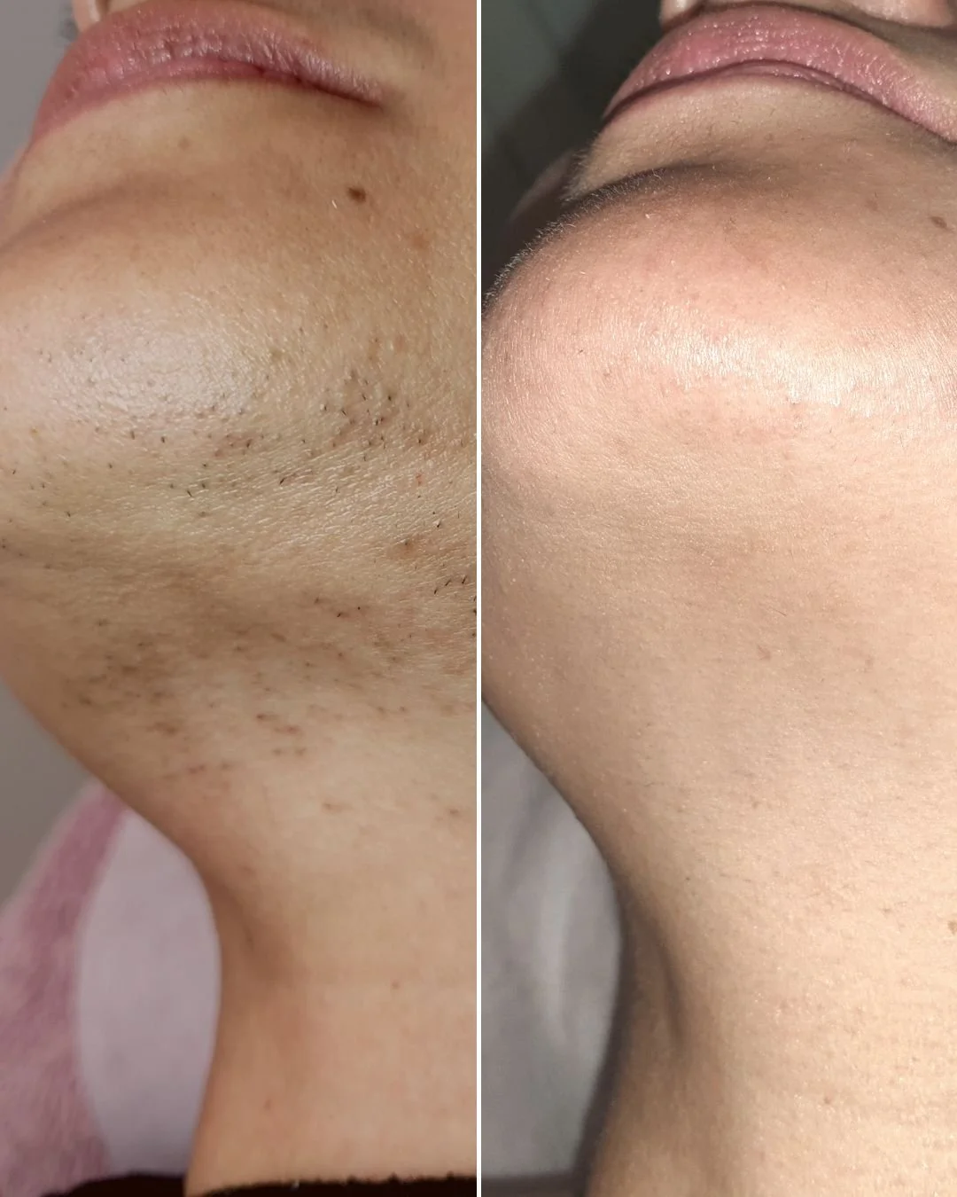 Check out these incredible results! Our happy client began treatment in 2020, and when she returned for a routine maintenance treatment, she was still hair free 🙌

If you are sick of shaving, waxing, plucking and the hassles that come with temporary