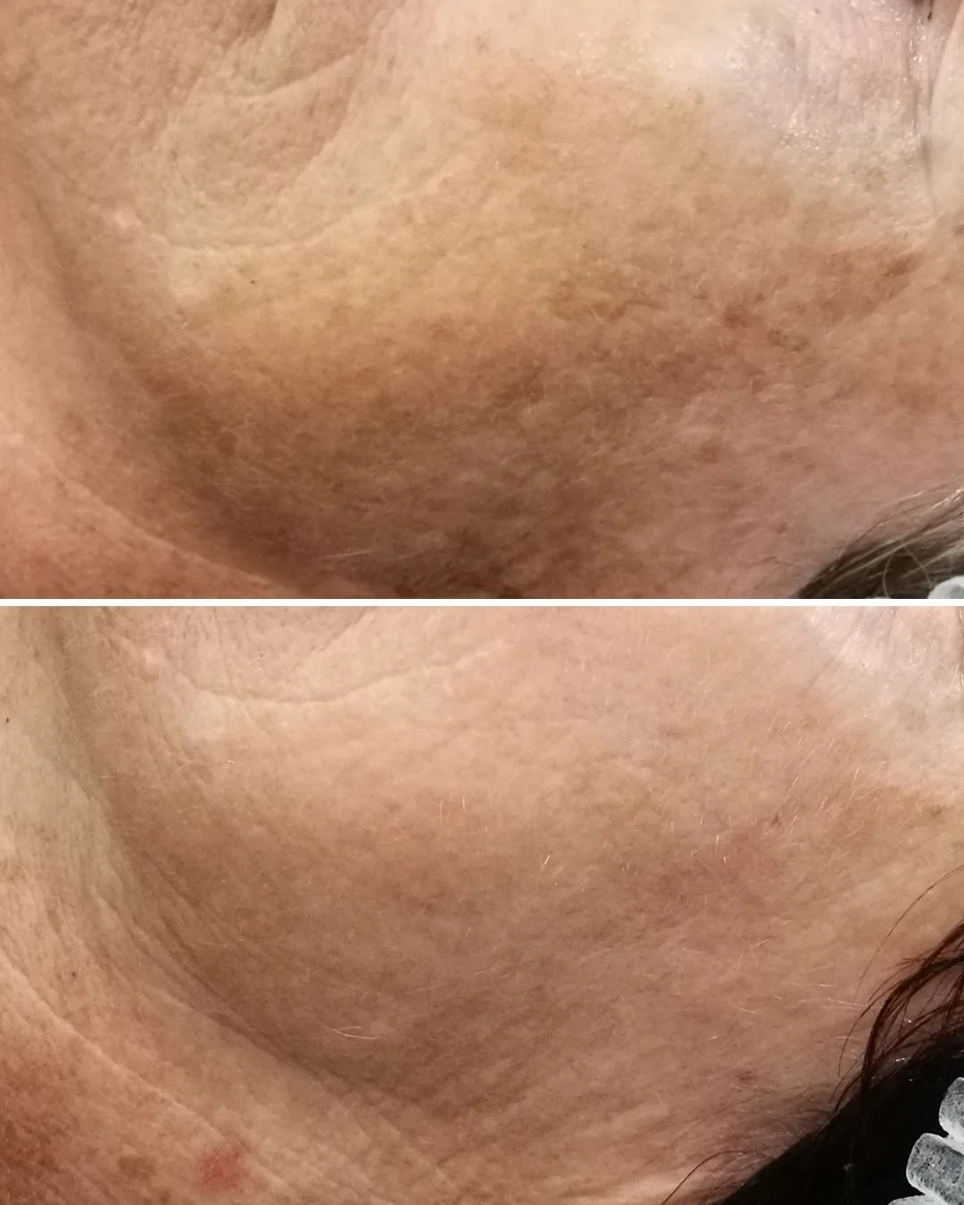 It is nearly impossible to avoid pigmentation at some point when we live in Western Australia and it's Mediterranean climate. We have UV index rating of 3 or above for majority of the year, this is why it is so important to wear SPF EVERY SINGLE DAY 