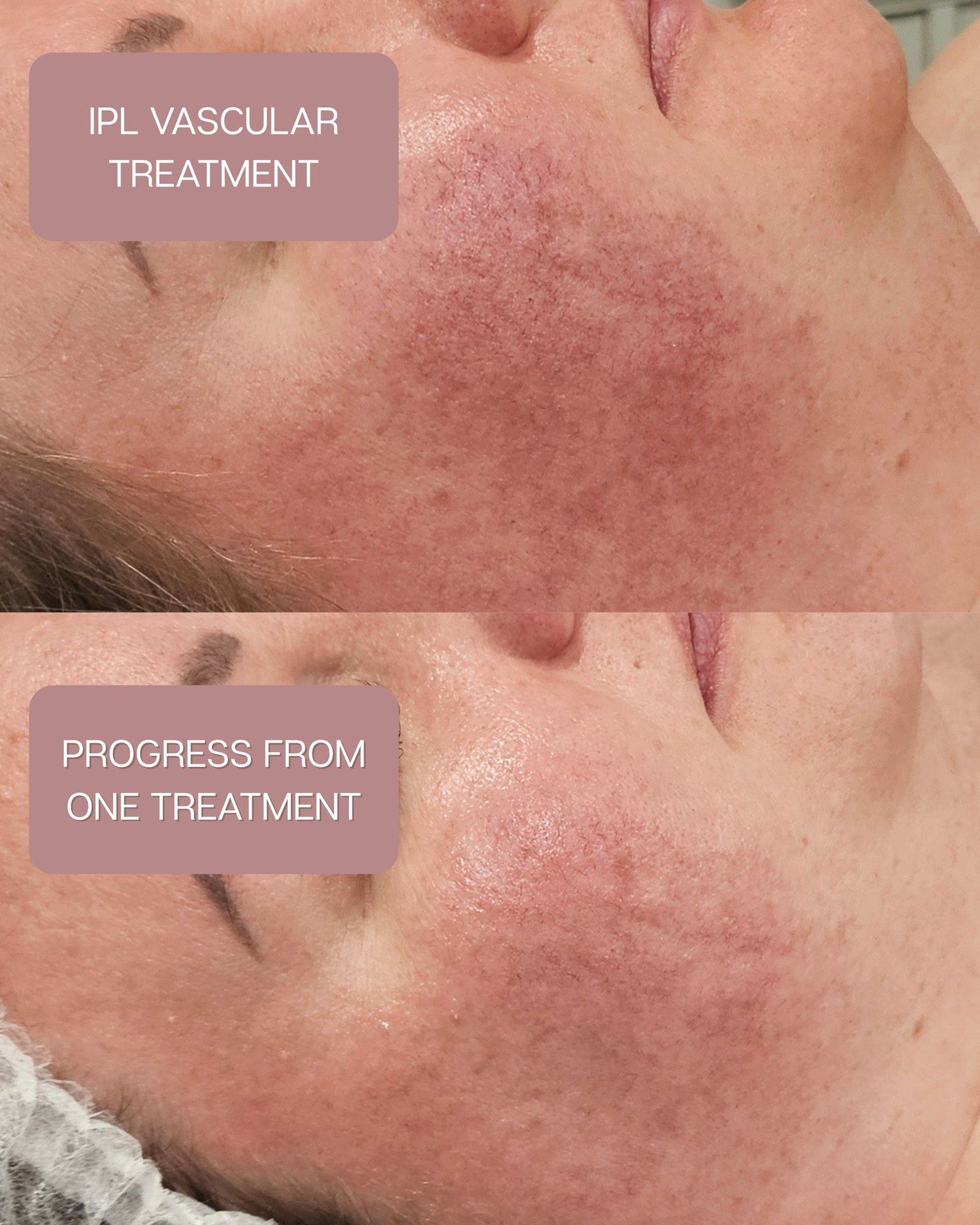 Want to know if IPL Skin Rejuvenation is right for you? Send us a message or book your IPL Consultation and test patches online

#professionalskintherapist #perthskin #perthskintreatments #facialredness #careforyourskin #ipltreatment #roadtohealthysk