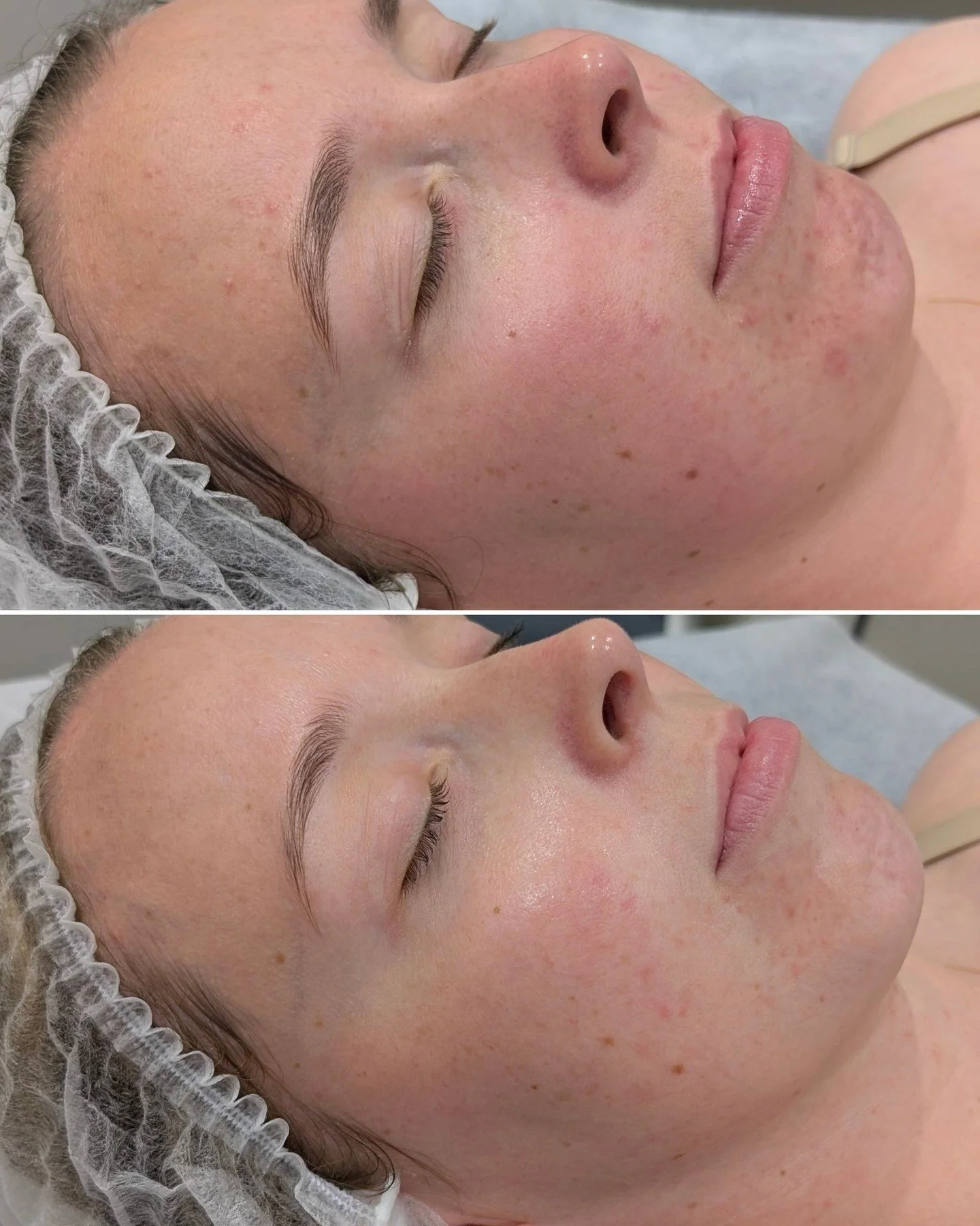 Strengthen and Repairing - This is just the beginning of great things to come

LED plus Pomegranate Peels with a simple home care regime consisting of:

🫧Gentle Antioxidant Cleanser
💤Recovery Cream
🌞Mineral Pro
🌿Medi Soothe
🧠B12 smart serum

#cl