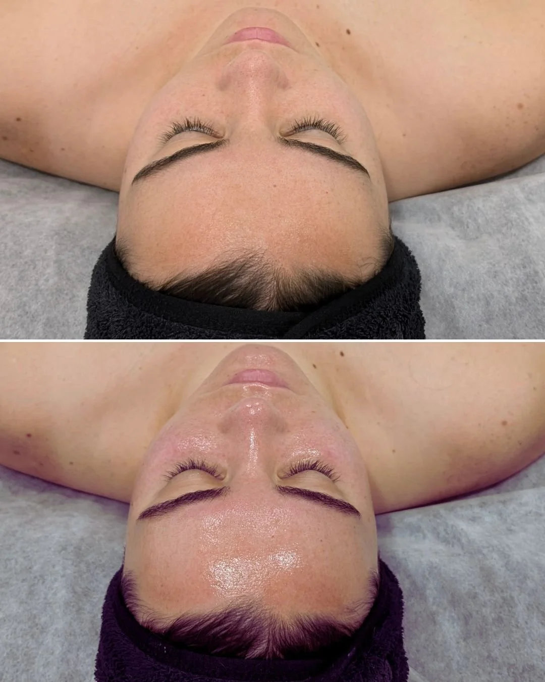 Epidermal Levelling AKA Dermaplaning is a non-invasive cosmetic treatment that involves scraping off dead skin cells and peach fuzz with a scalpel to leave your face brighter and smoother.

The number 1 question we get asked is &quot;but isn't that t
