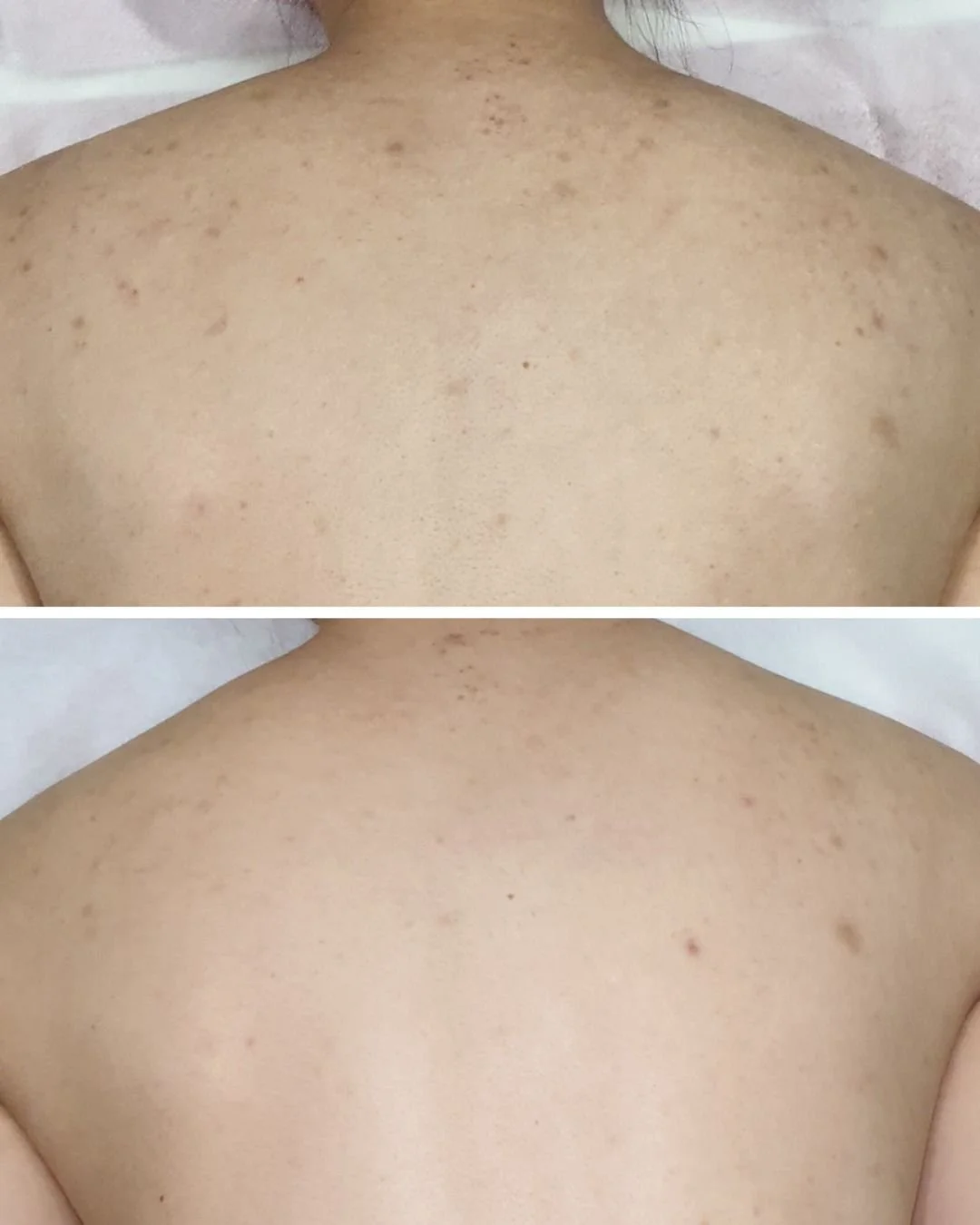 How amazing are these results? 🙌

This lovely client was concerned with breakouts and post-inflammatory pigmentation across her back.

We treated the area with a combination of the Geneo Balancing and Illuminating Treatments plus LED Light therapy.
