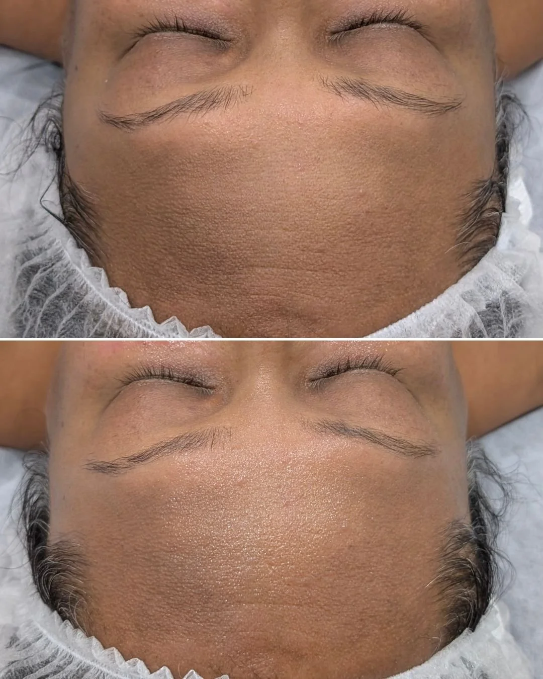 Discover the Benefits of Professional Dermaplaning!

Many know dermaplaning as a method for removing fine vellus hair, but it offers so much more! This exfoliation treatment, performed by a trained professional, presents a variety of benefits that ca