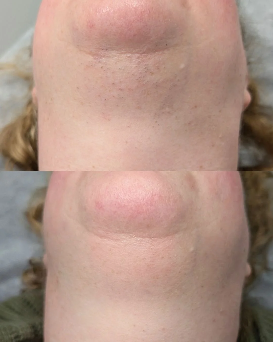 🌟 RESULTS FROM 2 TREATMENTS 🌟

We're thrilled to celebrate the incredible transformations our clients are experiencing with our Permanent Hair Reduction Treatments! Whether you're dealing with regular hair growth or hormonal hair challenges, these 