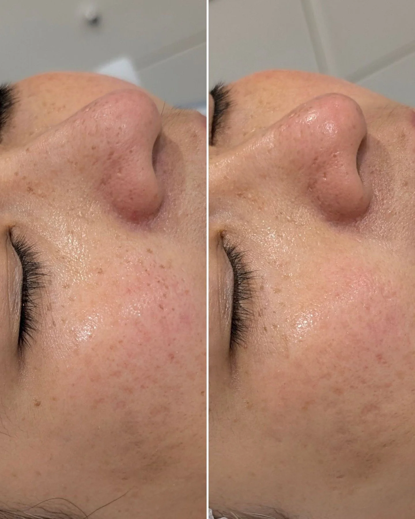 Progess from 2 treatments 🙌 Pigmentation reduction and overall rejuvenation for glowing, healthy skin

#skinclinicperth #dullskin #pigmentationtreatment #professionalskintreatments #darkspotsolution #oharaskinandbodyclinic #perthskin #pigmentationso