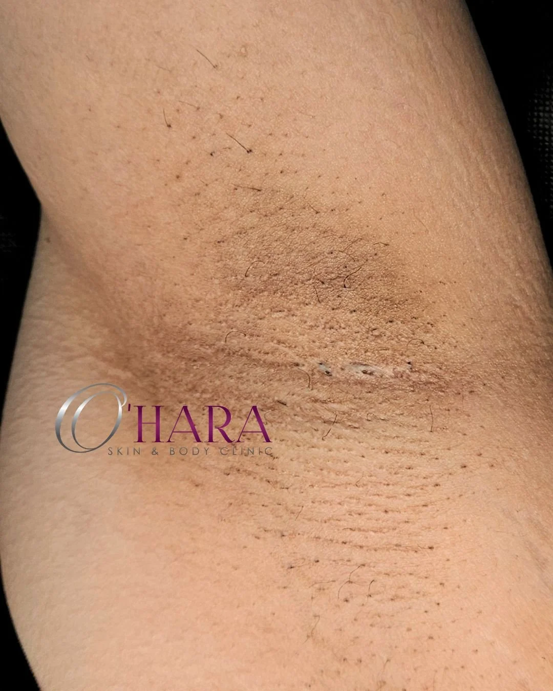 ✨ SWIPE TO SEE REAL RESULTS | JUST 2 TREATMENTS IN ✨

We often think of pigmentation as something that shows up on our face or hands &mdash; but for many people, discolouration appears in more intimate areas too&hellip; and it&rsquo;s completely norm