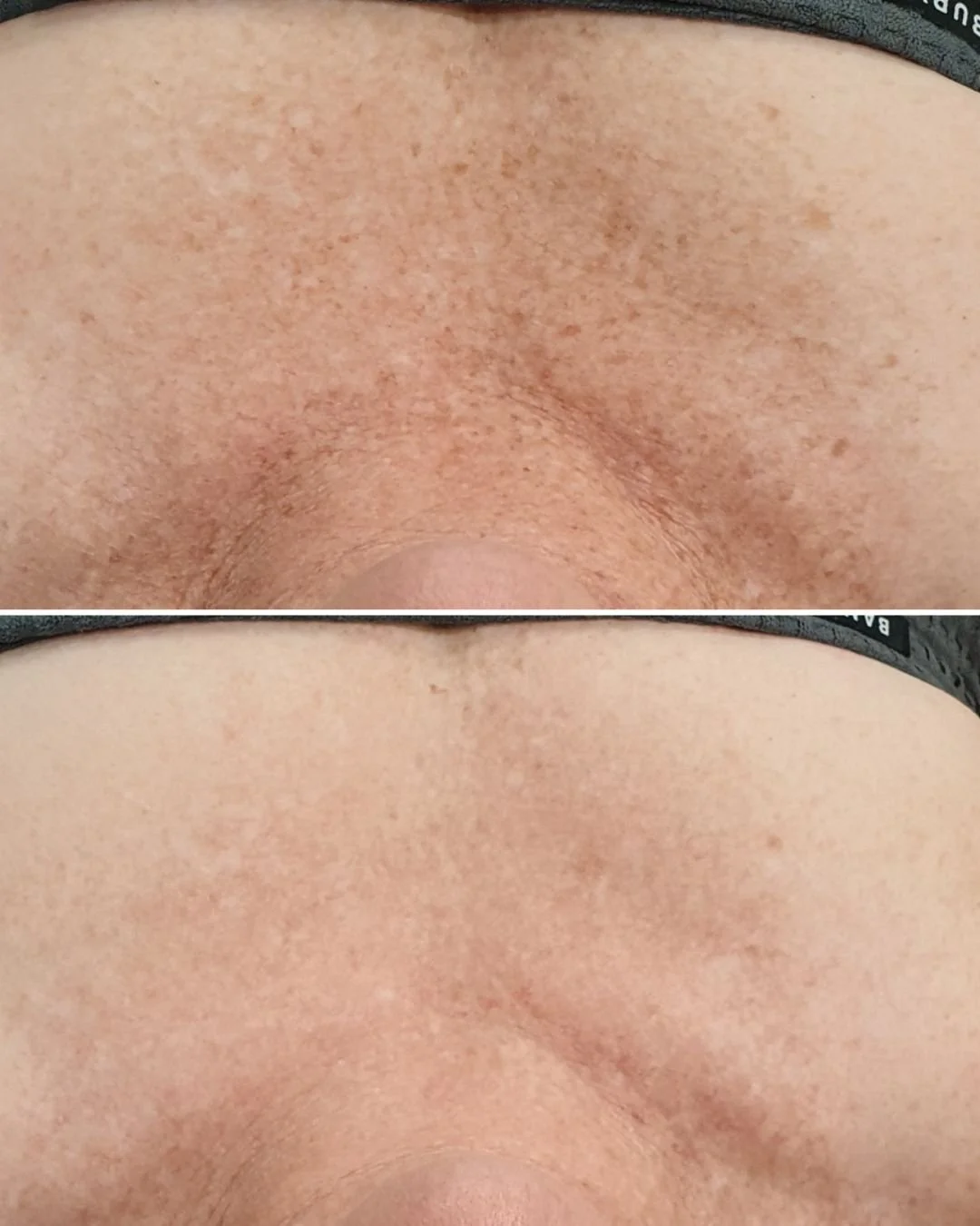 IPL Skin Rejuvenation for sun damage This client achieved these amazing results after only 3 treatments! If you have been thinking about treating your sun damage now is the perfect time to consider it as we start coming into the cooler months.

IPL e