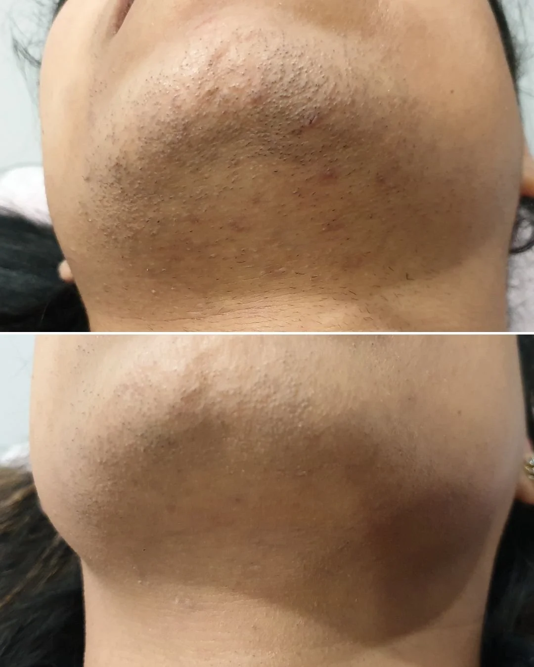 🌸Permanent Hair Reduction Treatments for any hair, but especially hormonal hair can be life changing. We absolutely love when our guests share how confident they feel when they see the results. 💪

If you are one of many people that must endlessly p