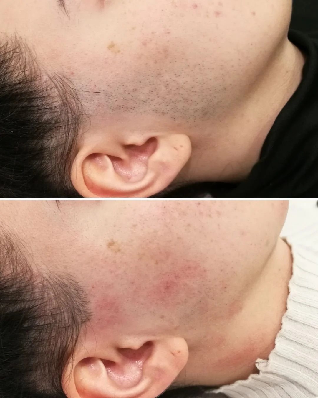 This is hair freedom!

Our client completed a course of hair removal treatments and now has maintenance sessions to keep her skin hair free permanently

DM or comment if you watch to wave goodbye to shaving, plucking and waxing 👋