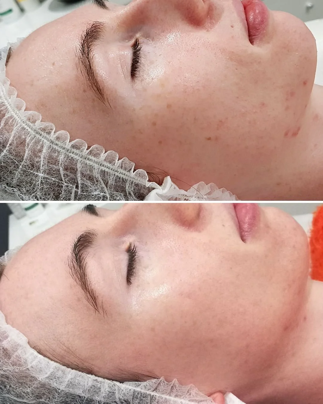 Results from IPL Skin treatments!⠀⠀⠀⠀⠀⠀⠀⠀⠀
⠀⠀⠀⠀⠀⠀⠀⠀⠀
 🏆Clarity⠀⠀⠀⠀⠀⠀⠀⠀⠀
 🏆Collagen and Elastin production = plumping ⠀⠀⠀⠀⠀⠀⠀⠀⠀
 🏆Smoother Texture⠀⠀⠀⠀⠀⠀⠀⠀
 🏆Reduction of Pigmentation⠀⠀⠀⠀⠀⠀⠀⠀⠀
 🏆Reduced Redness⠀⠀⠀⠀⠀⠀⠀⠀⠀