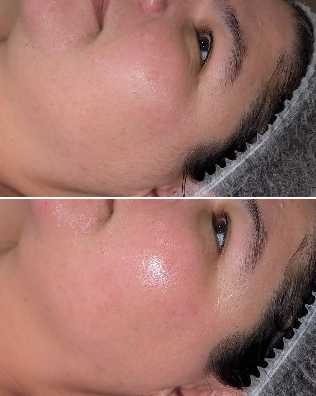 Epidermal Levelling, also known as Dermaplaning = Smooth, glowing skin 🔦
