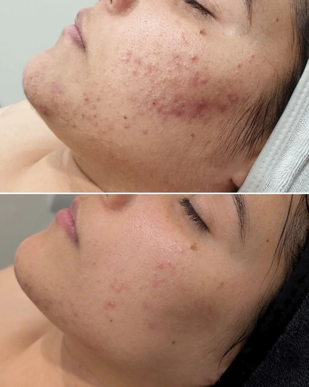 Achieving consistently clear skin is probably easier than you may think.

It all starts with an in-depth skin analysis. It might sound boring if you want to just lay on a treatment bed and fall asleep during a nurturing facial, but it is the key to f