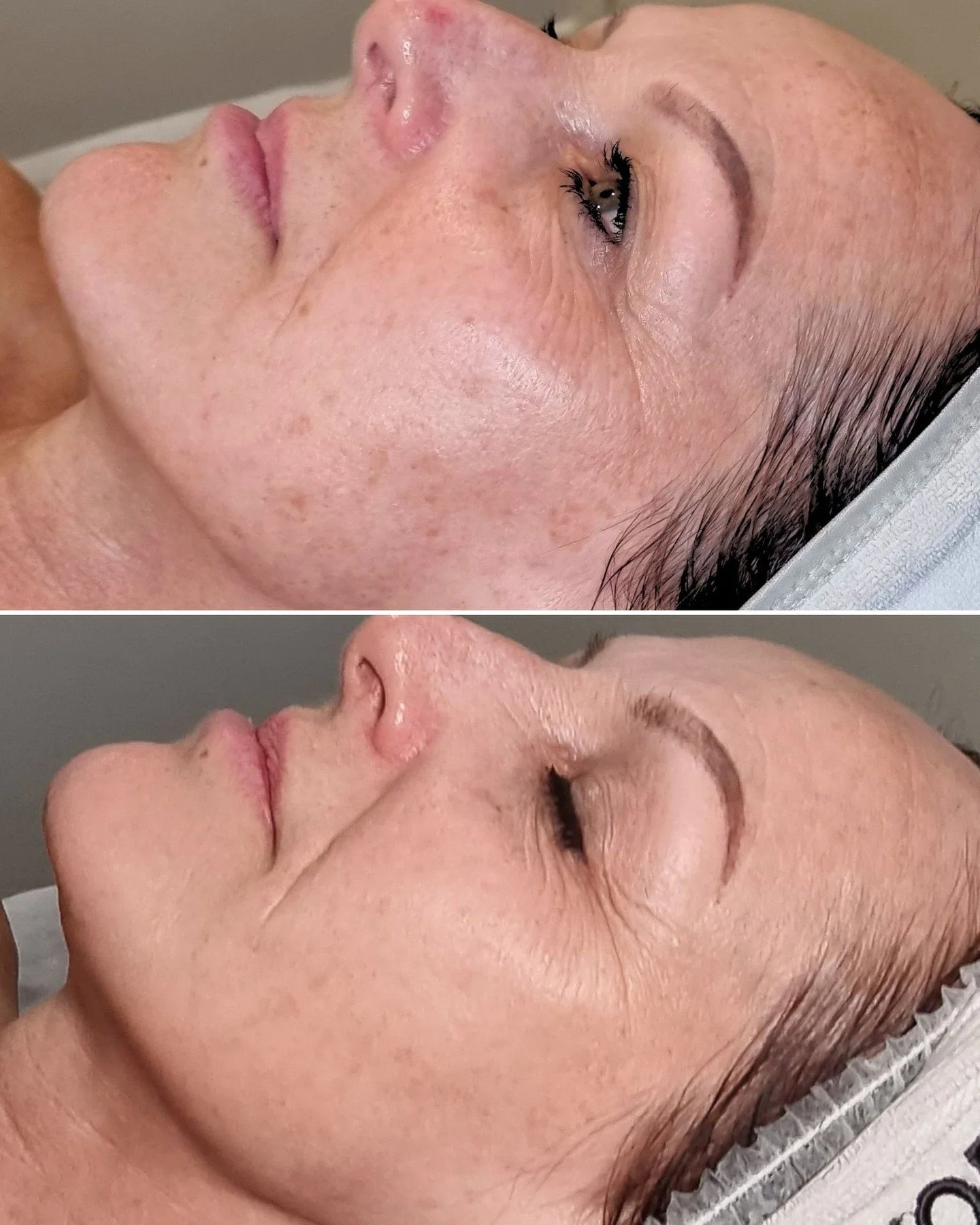 Can you believe these amazing results from just ONE IPL rejuvenation treatment?

Have you ever wondered how IPL, or Intense Pulsed Light therapy, works wonders not just for hair removal but also for transforming your skin? It&rsquo;s true!

Imagine b