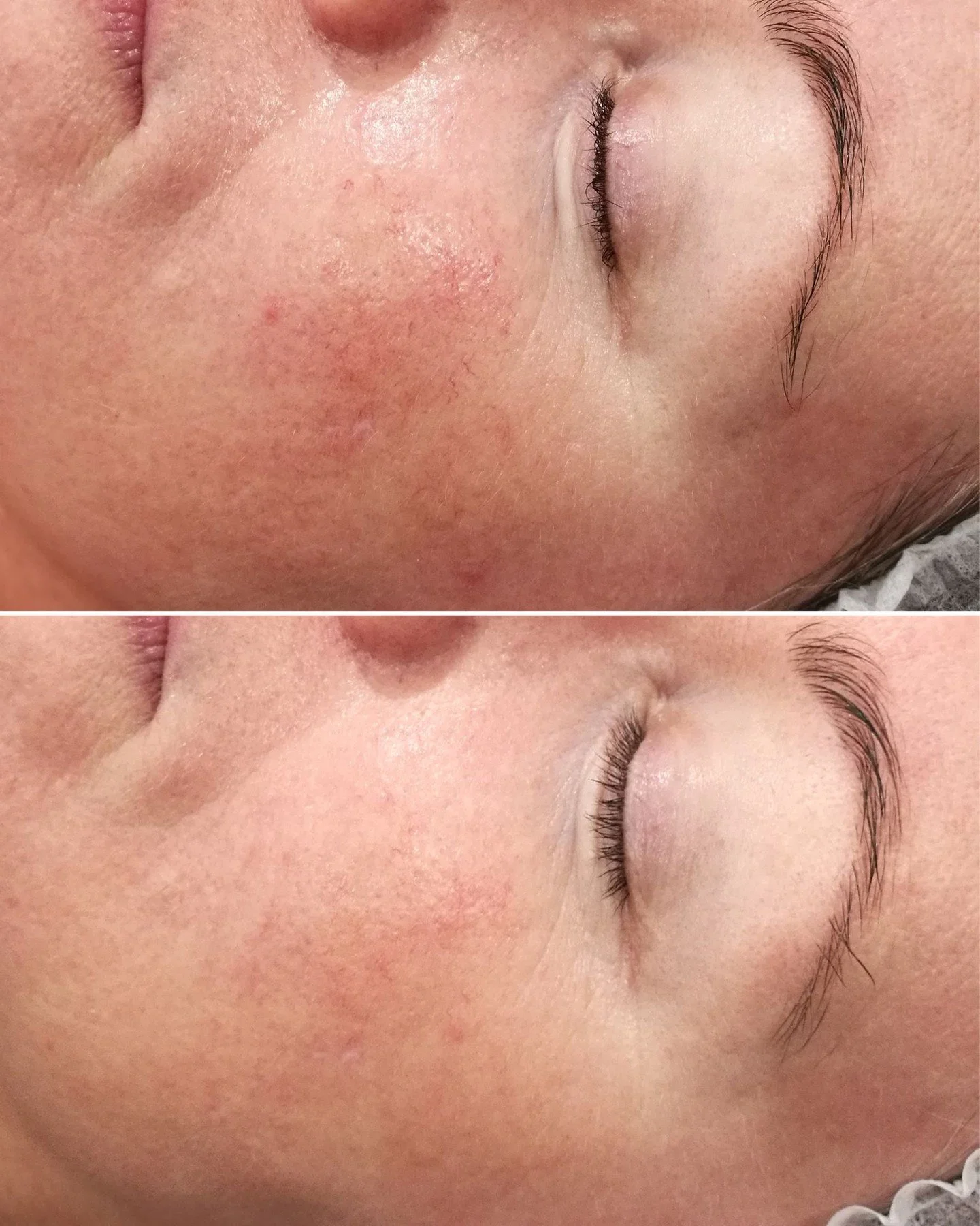 Redness Solution ⬇️

IPL Photo Rejuvenation is an advanced cosmetic treatment designed to produce younger and healthier-looking skin. As we age, most people find their complexions impacted by sun damage, time, and lifestyle choices. Photo Rejuvenatio