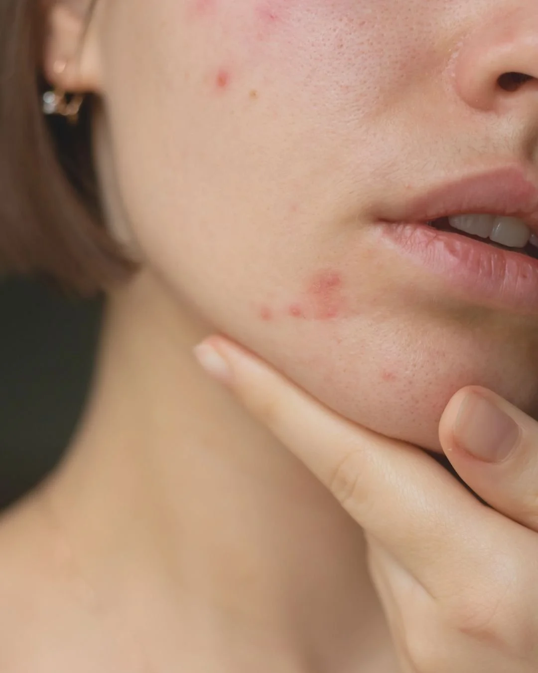 Let&rsquo;s talk acne! You're definitely not alone&mdash;millions are in this together!

Whether it's the occasional pesky pimple or persistent cystic acne, we get it! Tackling acne is all about finding the right match for your skin type, its severit
