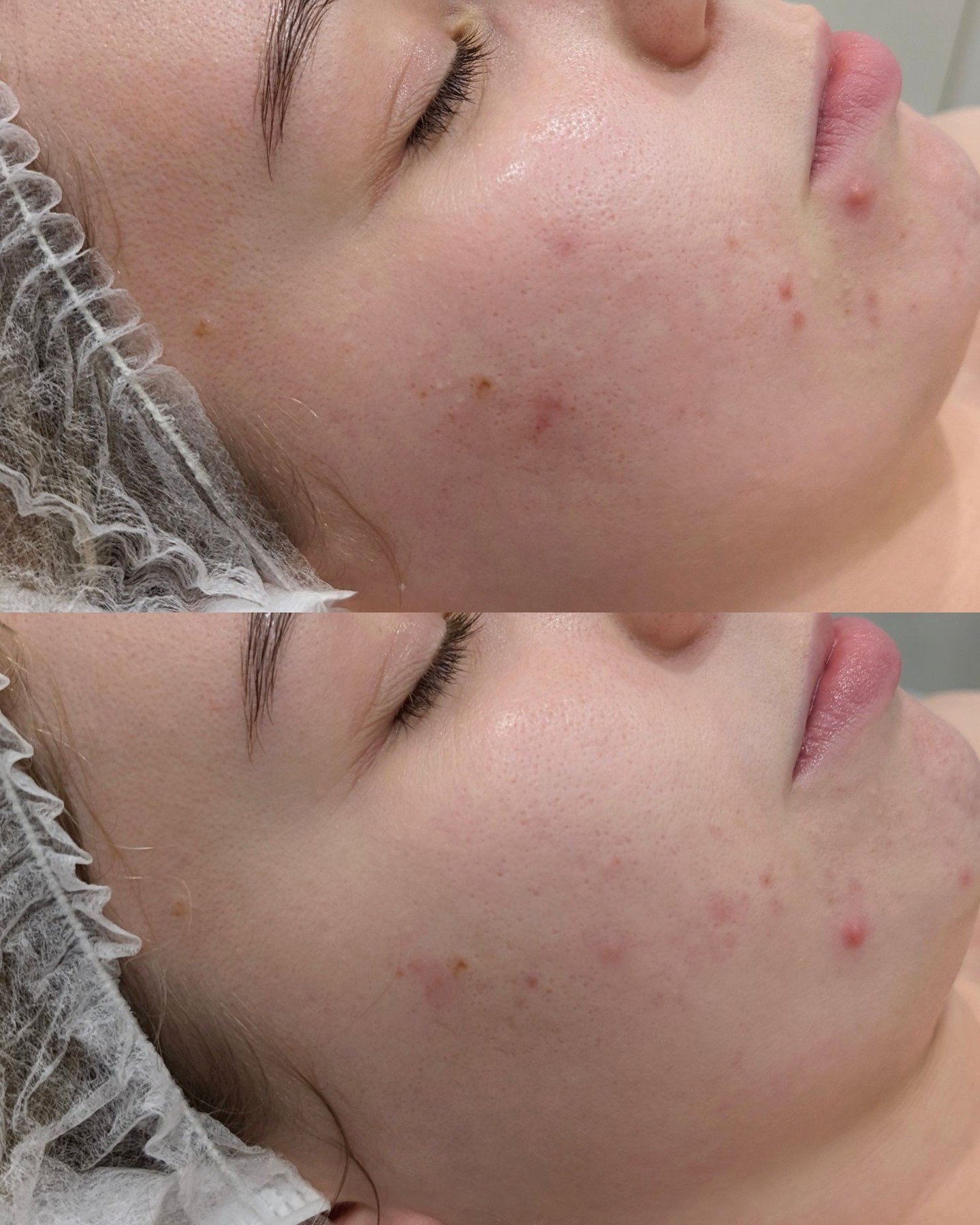 Having one treatment won't be like waving a magic wand and getting your dream skin but it will be a step towards your goals, it's important to notice the progress you make along your skin journey.

Results from ONE skin Needling and already a visible
