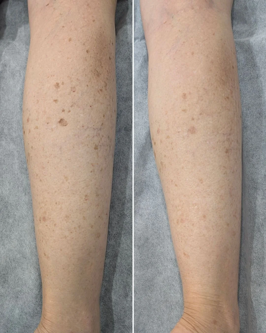 When it comes to IPL it's pretty common knowledge that it is a super effective treatment for permanent hair reduction, but did you know we use it all over the body to remove unwanted pigmentation?

Our client is so impressed with her progress so far 