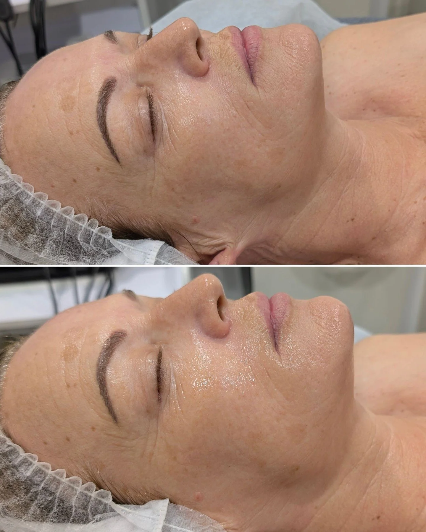 Immediate results from Geneo X using our Gold Glam Oxypod💛

Geneo X is the big sister to the beloved Geneo treatment. All the benefits of Geneo with the added contouring benefits from TriPollar RF (Radio Frequency) and ESA (Electrical Skin Activatio