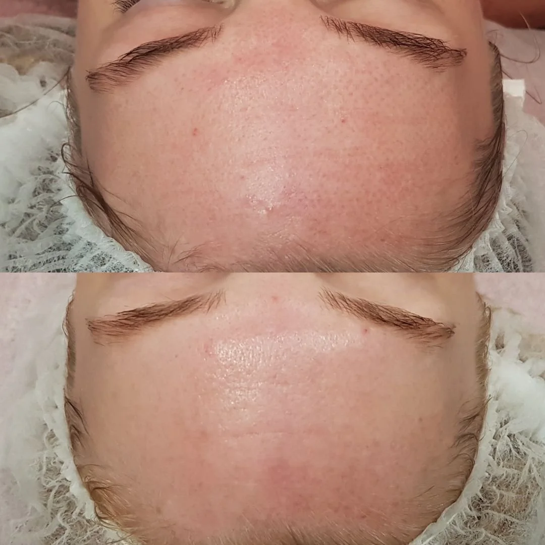 Not all Plasma Fibroblast treatments are performed the same. Factors that could effect your results and potentially lead to undesirable outcomes include quality of the device, therapist experience and level and/or quality of training. Receiving corre