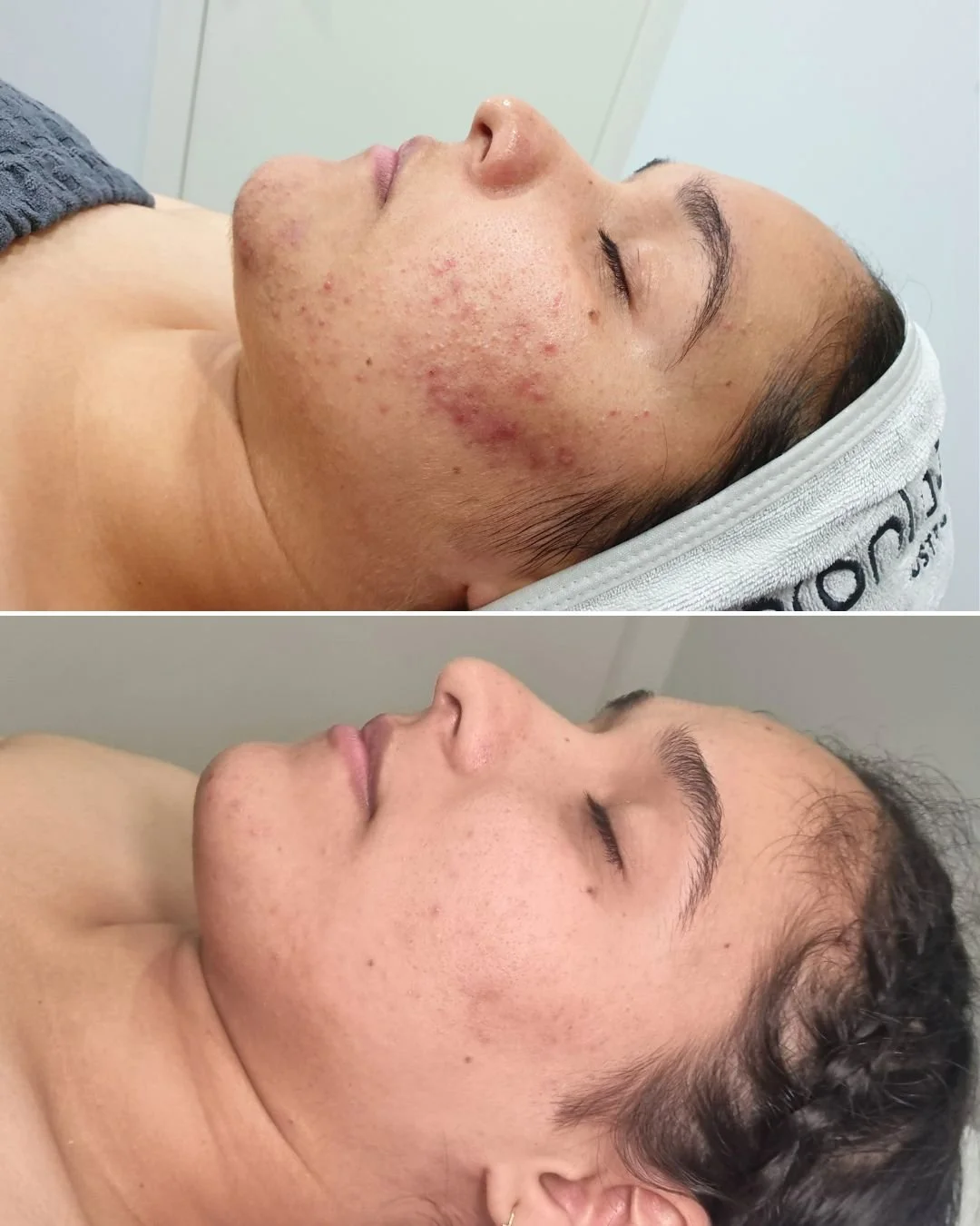 🌟 Transforming skin, transforming confidence! Just look at the incredible journey our client has embarked on with a personalized treatment plan of Geneo Balance, LED Light Therapy and Fusion Mesotherapy treatments. The results speak for themselves &