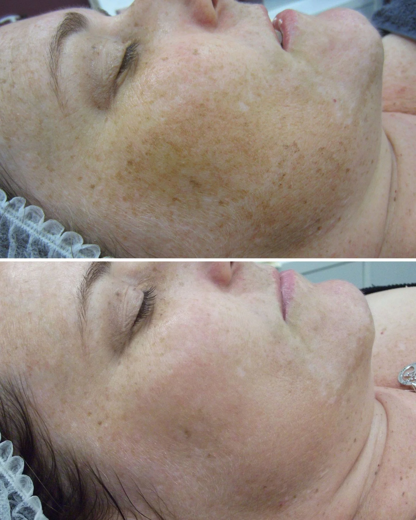 Do you want smooth, even and healthy skin? We are here to help 🥰

Results from 1 IPL Treatment!