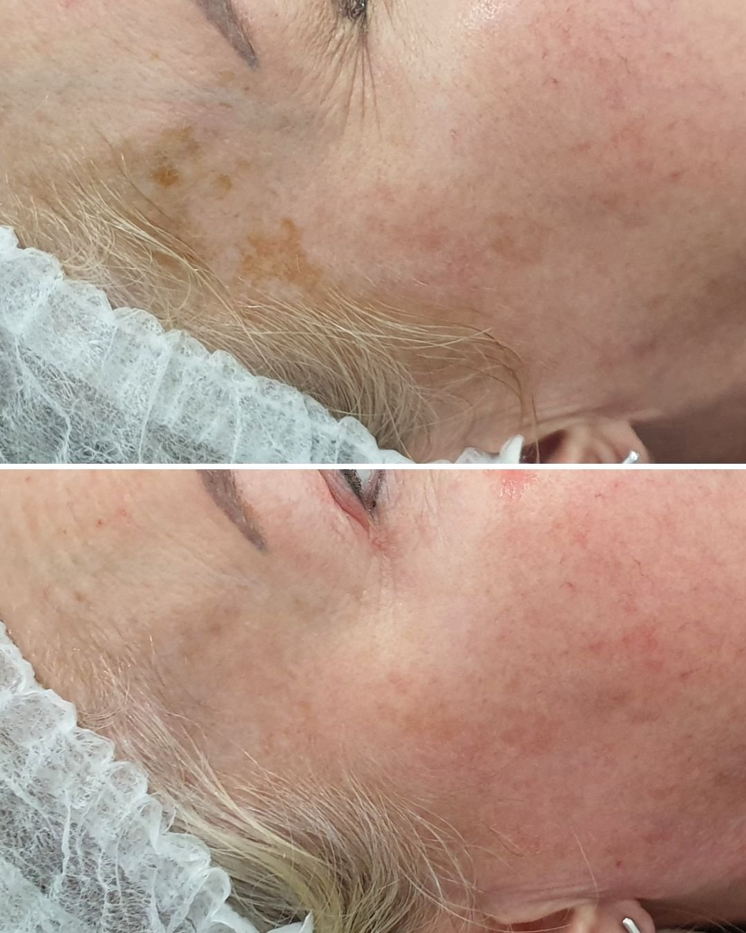 It is nearly impossible to avoid pigmentation at some point when we live in Western Australia and it's Mediterranean climate. We have UV index rating of 3 or above for majority of the year, this is why it is so important to wear SPF EVERY SINGLE DAY 