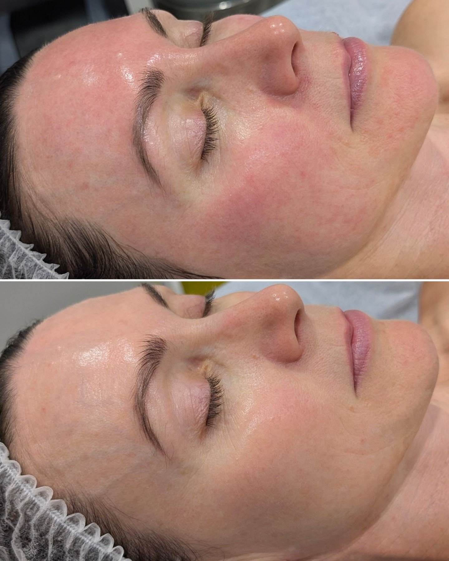 𝗦𝗘𝗡𝗦𝗜𝗧𝗜𝗩𝗜𝗧𝗬, 𝗖𝗢𝗠𝗣𝗥𝗢𝗠𝗜𝗦𝗘𝗗 𝗕𝗔𝗥𝗥𝗜𝗘𝗥, 𝗥𝗘𝗗𝗡𝗘𝗦𝗦, 𝗥𝗘𝗔𝗖𝗧𝗜𝗩𝗘 𝗦𝗞𝗜𝗡

Whatever it's called and whatever it means to you, we are here to help.

Our client came to us mainly wanting to prevent ageing. Before we begin