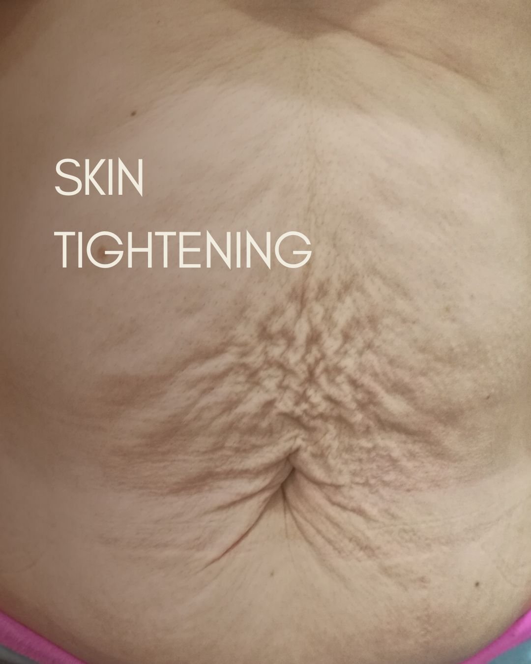 ✨ **Experience the Magic of Plasma Fibroblast Skin Tightening!** ✨

Discover a revolutionary non-surgical skin rejuvenation treatment designed to enhance your natural beauty! Plasma fibroblast therapy offers incredible results for both the face and b