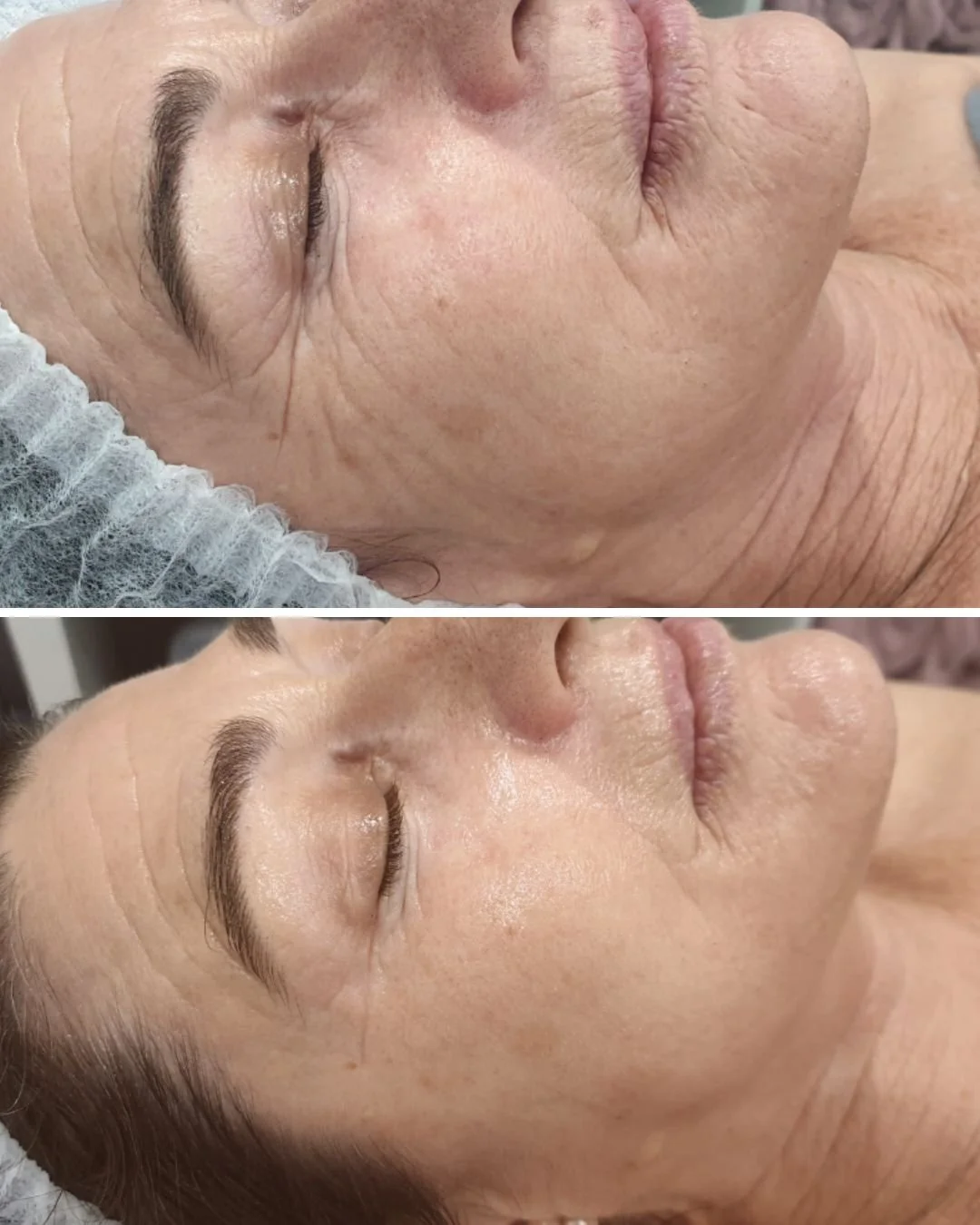 Immediate results following Geneo and RF 😍🤯