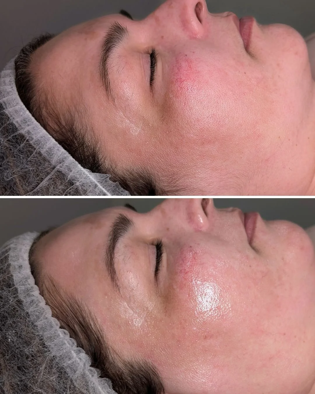 Say goodbye to the myth that dermaplaning makes hair grow back thicker&mdash;because it's simply not true!

Unlock the secret to effortlessly smooth, healthy skin with Epidermal Levelling (also known as dermaplaning or epi-blading). If you&rsquo;re s