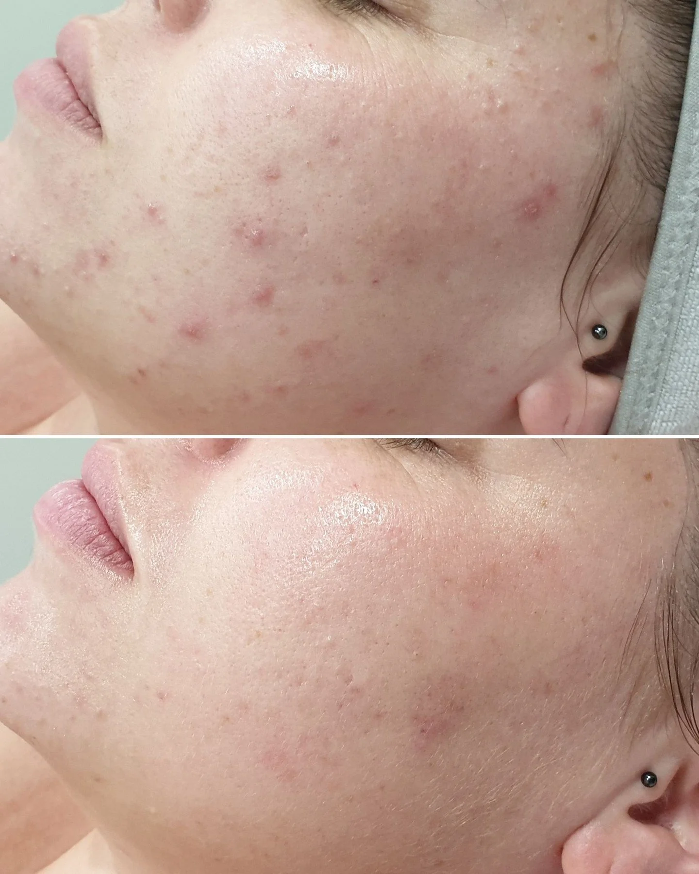 This is #progress 🙌

Our beautiful client originally came to us with compromised skin, concerned with congestion. Her journey started with Lymphatic Therapy to flush any toxins and increase nutrient absorption to begin healing and strengthening the 