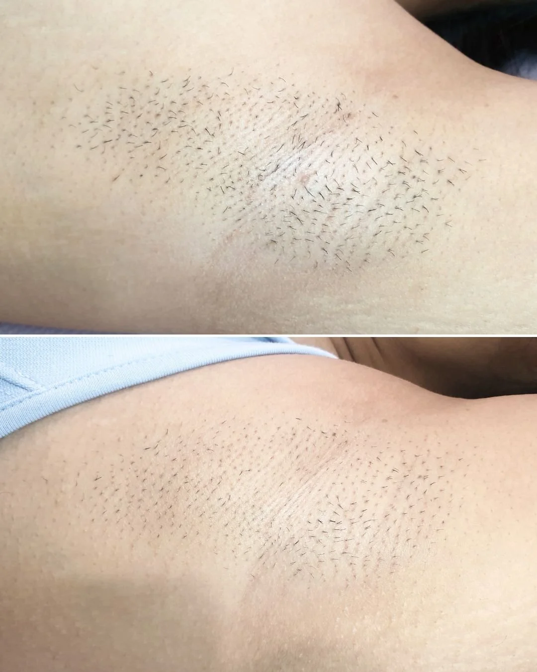 Check out this mind-blowing progress shot after just TWO IPL treatments! 🌟 Our client is absolutely loving the results and is already thinking about what other areas to target next! ✨

Even though a course of 6-8 treatments is recommended for the be