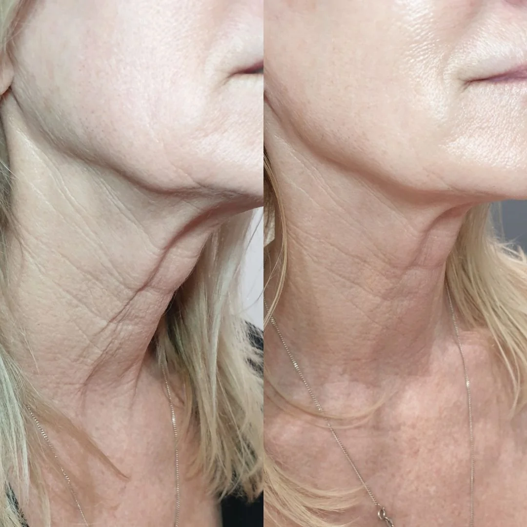 Our necks are an area that tend to get forgotten about when we treat our skin, that is until we start to notice that the skin isn't ageing as well as our face. Plasma fibroblast is just 1 of the many treatments we offer to help correct skin on the ne