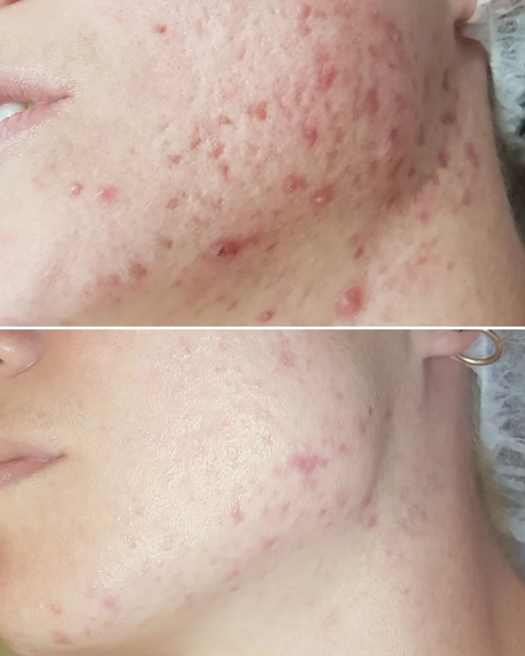 When treating your skin, your homecare makes up for 70% of your treatment outcome! Just like diet and exercise, homecare and treatments go hand in hand to achieve the results YOU want, FASTER

Our beautiful client has achieved results through a combi