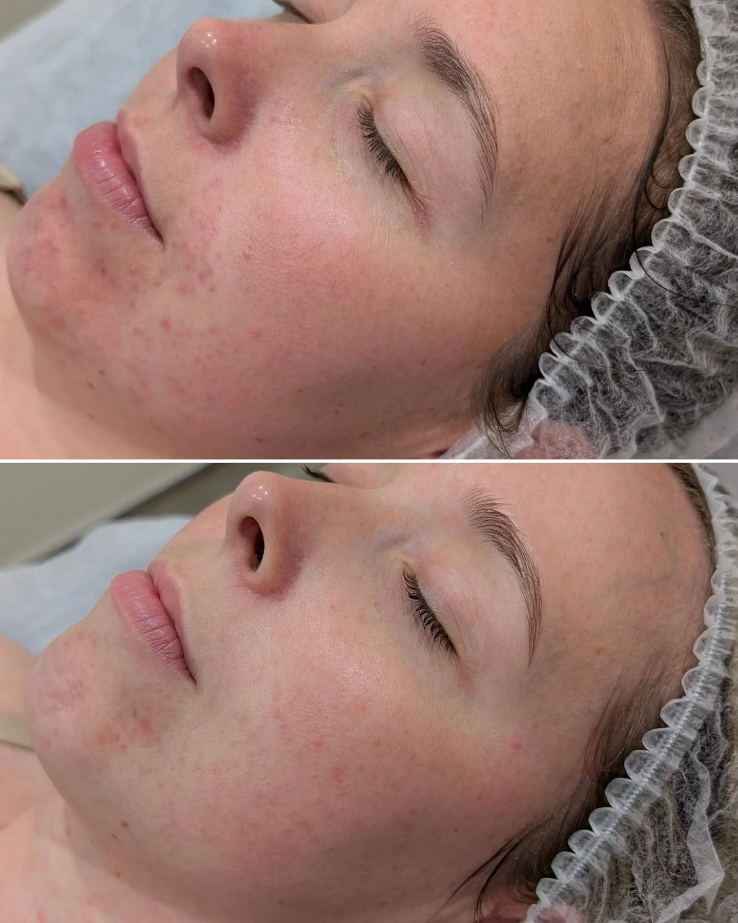 Strengthen and Repairing - This is just the beginning of great things to come

LED plus Pomegranate Peels with a simple home care regime consisting of:

🫧Gentle Antioxidant Cleanser
💤Recovery Cream
🌞Mineral Pro
🌿Medi Soothe
🧠B12 smart serum

#cl