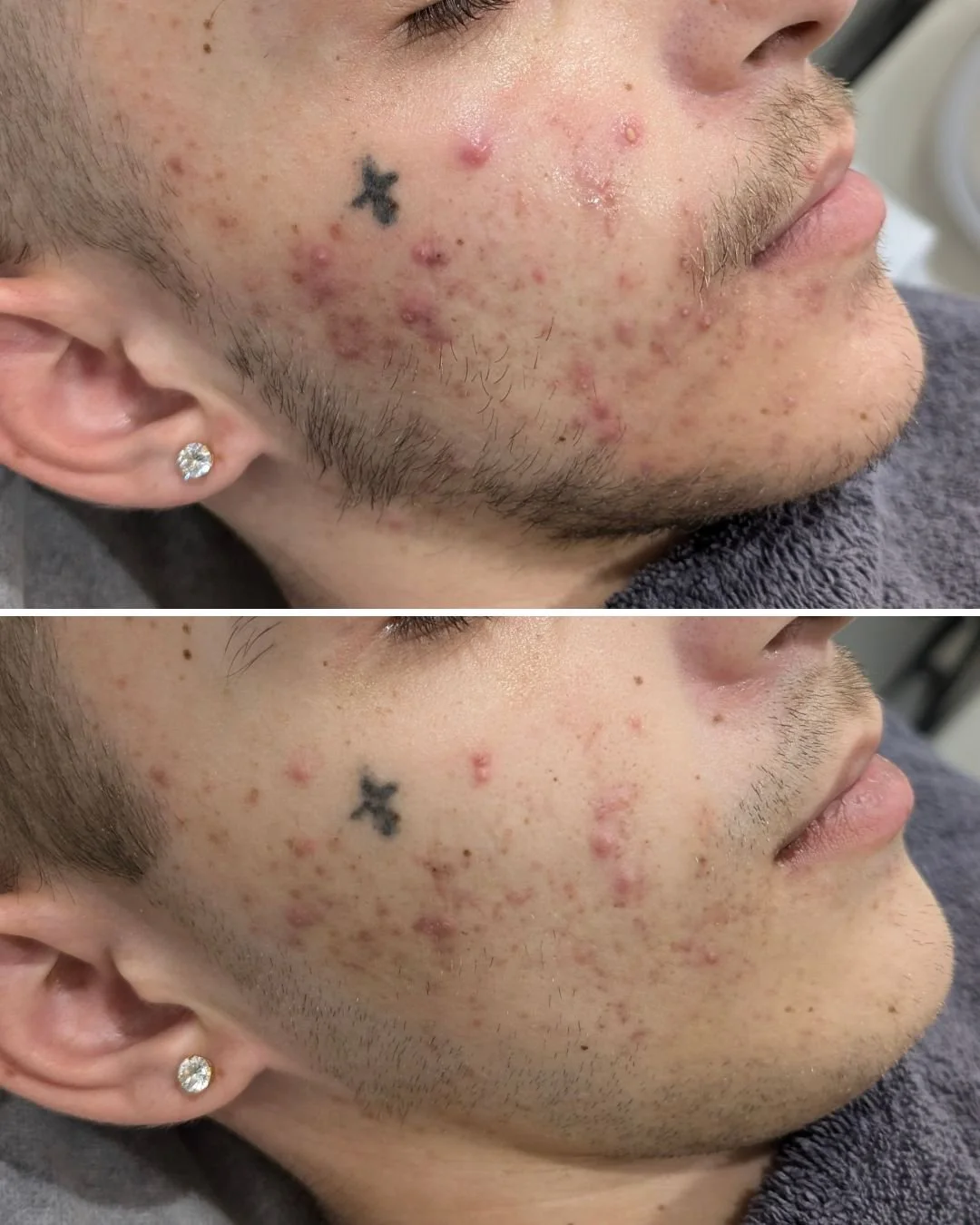 Witnessing a skin transformation like this is truly rewarding! When our client first came to us, his skin was incredibly sensitive and dry, with every topical application causing discomfort. Fast forward 6 weeks, and the results speak for themselves.