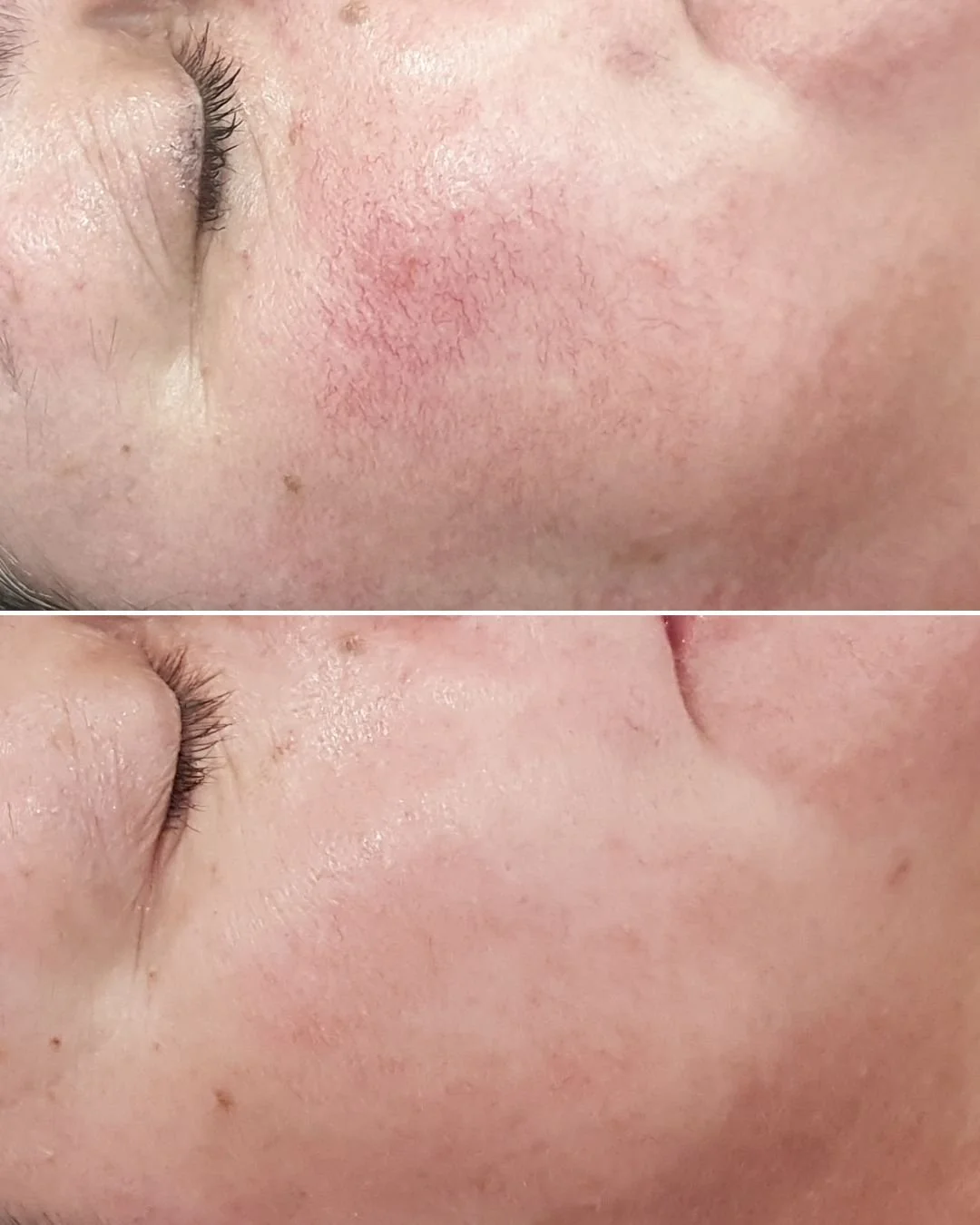 IPL Vascular Therapy!

Curious about how this incredible treatment works? Let&rsquo;s break it down!

𝗪𝗵𝗮𝘁 𝗶𝘀 𝗜𝗣𝗟 𝗩𝗮𝘀𝗰𝘂𝗹𝗮𝗿 𝗧𝗵𝗲𝗿𝗮𝗽𝘆?
This non-invasive procedure harnesses the power of Intense Pulsed Light (IPL) to effectively t
