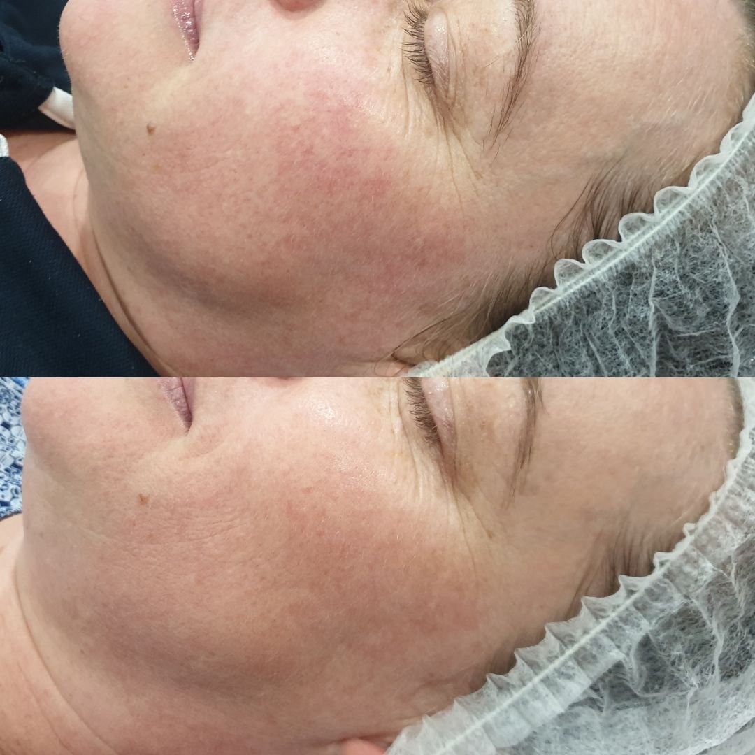 🦋 ONE TREATMENT 🦋

Do you have redness, rosacea or broken capillaries that bother you? IPL may be the perfect solution for you 💪

Basically, the blasts of light from IPL go down into your skin and constrict the red vessels.

DM us or book your IPL