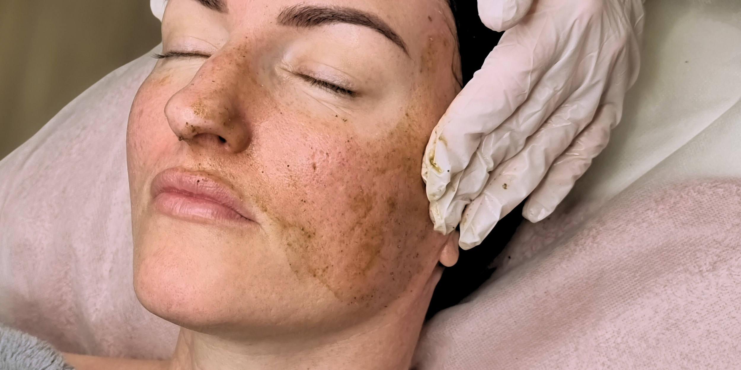 Dr Esthe Spicule Peels. Melasma Peel. Acne Scarring. Skin Clinic Perth. Southern River. Canning Vale. Piara Waters