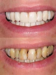 veneers.jpg