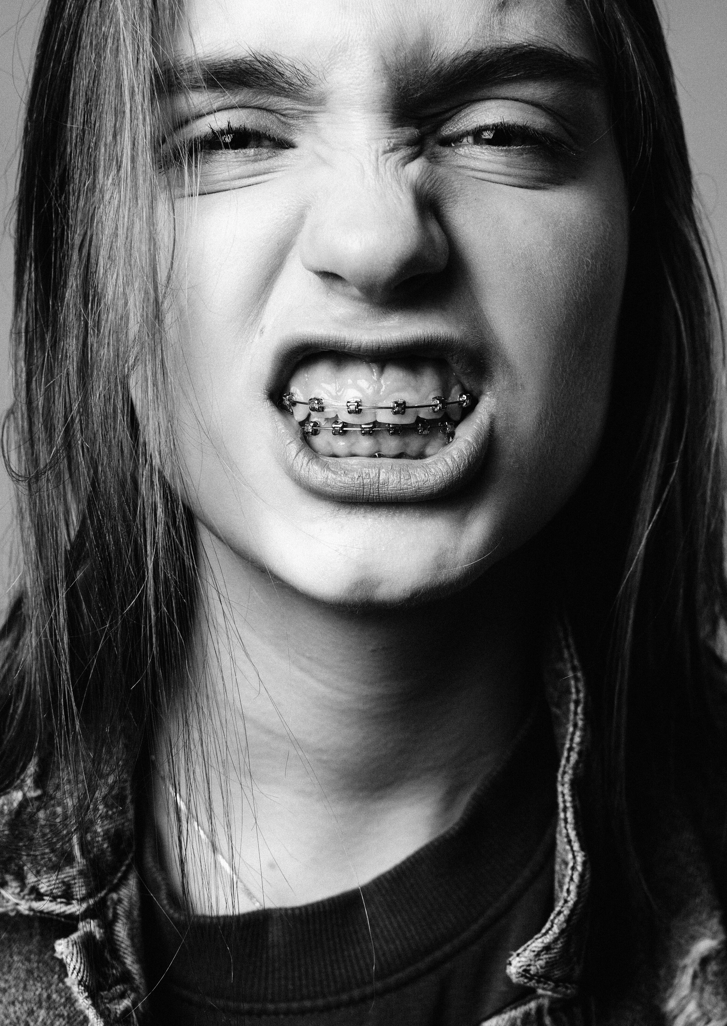 Person with mouth open showing braces and gums.