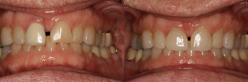 Before and After Dental Crowns and Dental Veneers Photos from West Ridgewood Dental Professionals in Bergen County NJ 