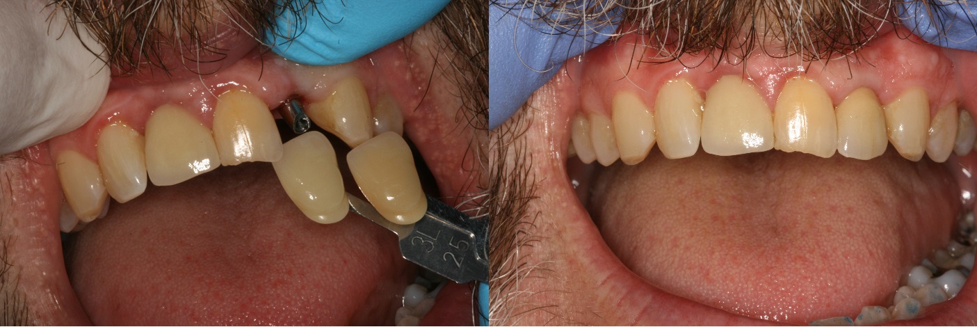 Before and After Dental Implant Crown Photos from West Ridgewood Dental Professionals in Bergen County NJ 