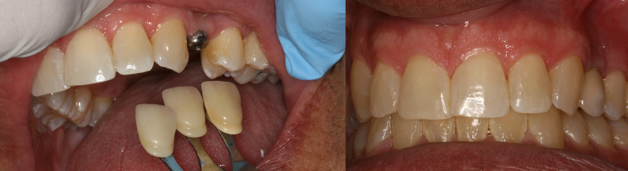 Before and After Dental Implant abutment and dental Crown Photos from West Ridgewood Dental Professionals in Bergen County NJ