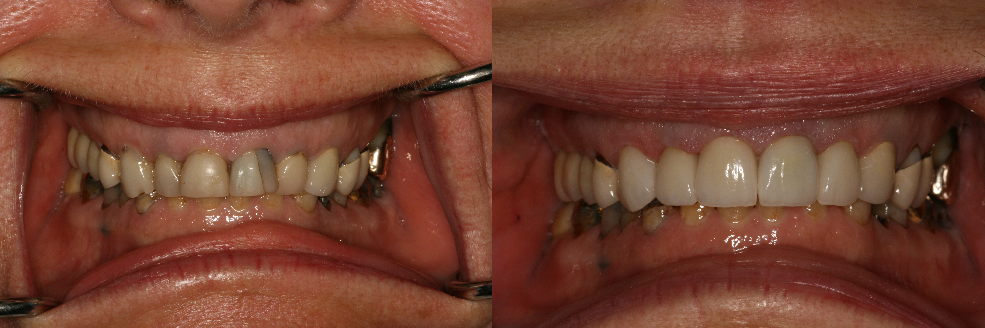 Before and After All Porcelain Ceramic Dental Crown Procedure Photos from West Ridgewood Dental Professionals in Bergen County NJ