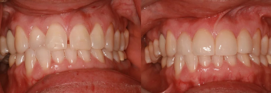 Before and After Dental Veneers and Crossbite from West Ridgewood Dental Professional in Bergen County NJ