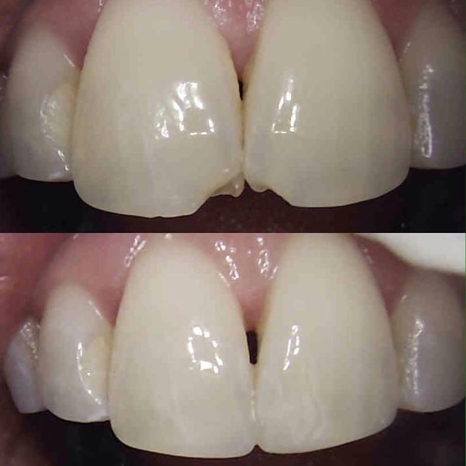 Dental Tooth Bonding, Cosmetic Dentist Orange Woodbridge Milford CT
